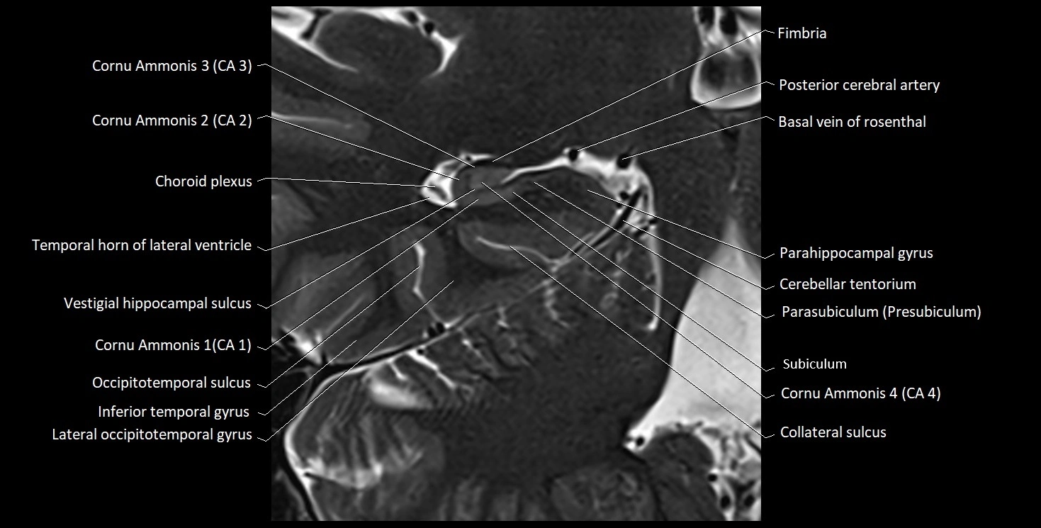 Hippocampus anatomy mri coronal cross section 3T MRI image 13.webp